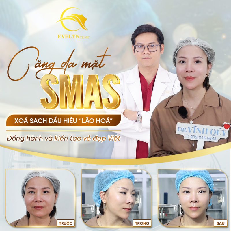 Phẫu thuật căng da SMAS có đau không?