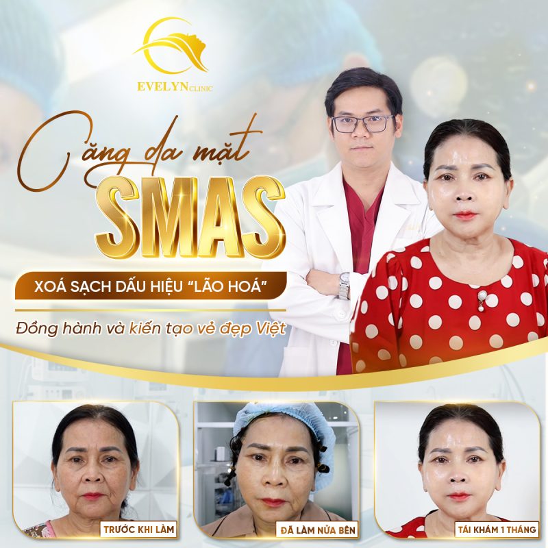 Phẫu thuật căng da SMAS có đau không? 1